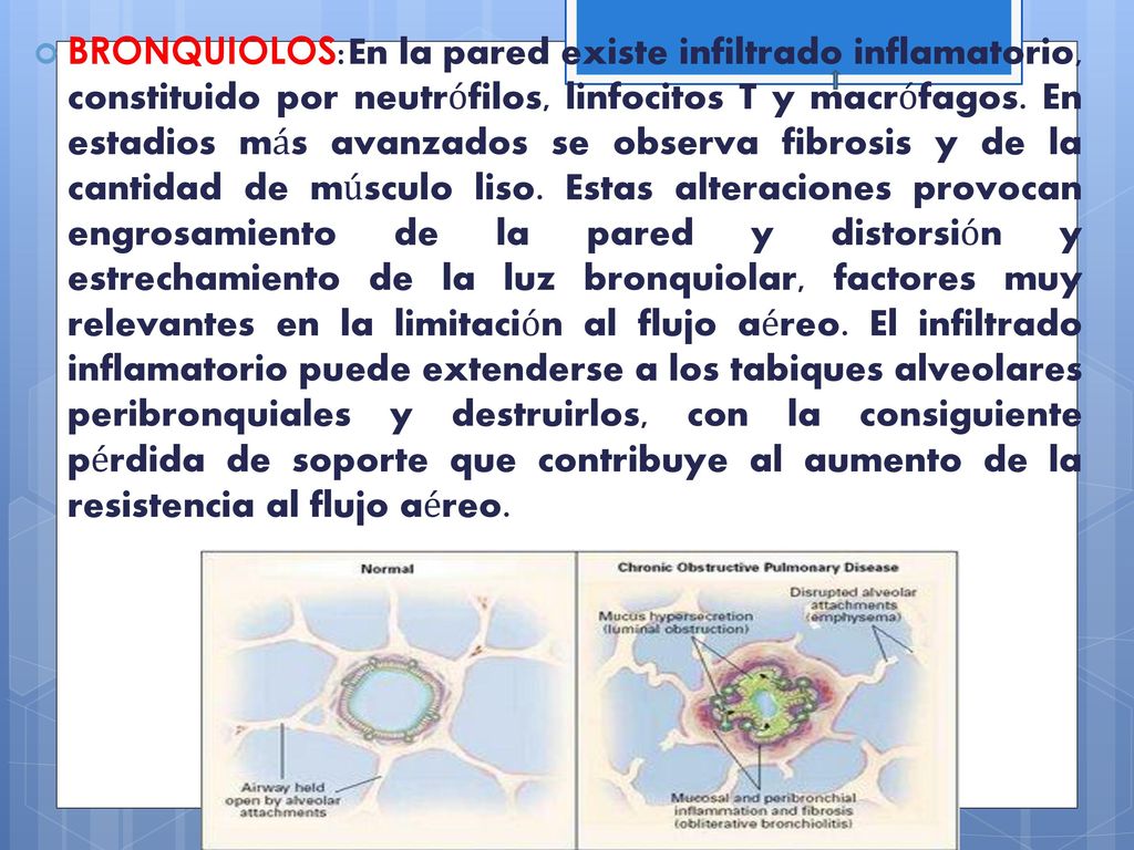 BRONQUIOLOS:En la pared existe infiltrado inflamatorio, constituido por neutrófilos, linfocitos T y macrófagos.
