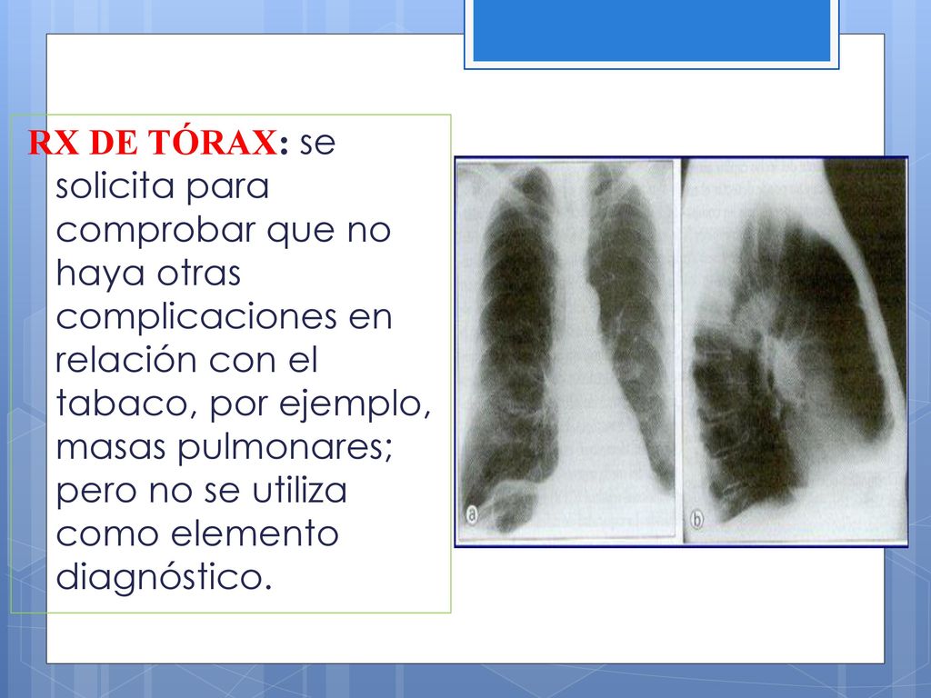 RX DE TÓRAX: se solicita para comprobar que no haya otras complicaciones en relación con el tabaco, por ejemplo, masas pulmonares; pero no se utiliza como elemento diagnóstico.