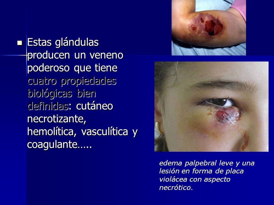 Estas glándulas producen un veneno poderoso que tiene cuatro propiedades biológicas bien definidas: cutáneo necrotizante, hemolítica, vasculítica y coagulante…..