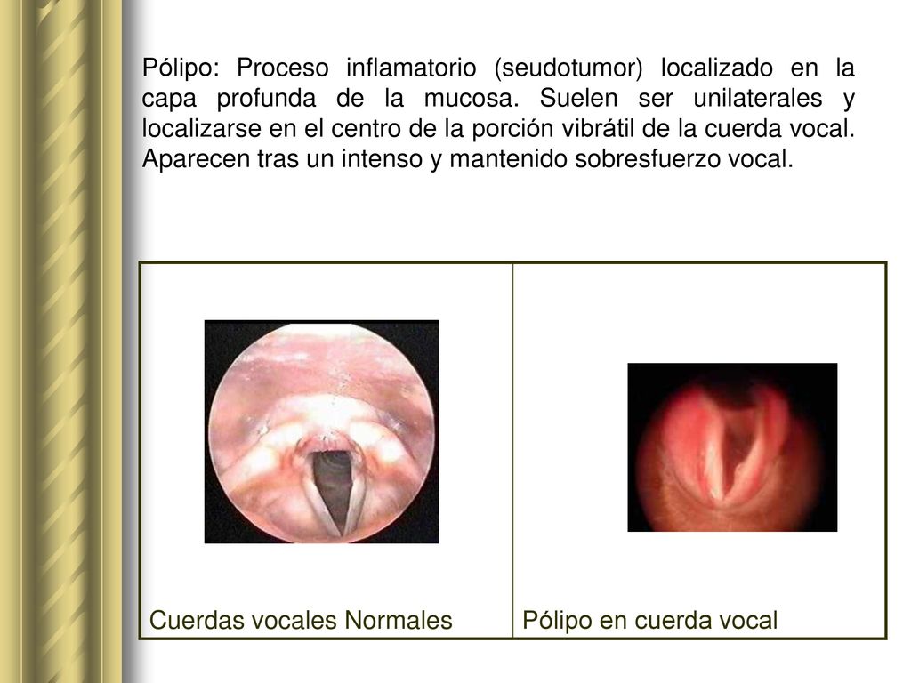 Pólipo: Proceso inflamatorio (seudotumor) localizado en la capa profunda de la mucosa. Suelen ser unilaterales y localizarse en el centro de la porción vibrátil de la cuerda vocal. Aparecen tras un intenso y mantenido sobresfuerzo vocal.