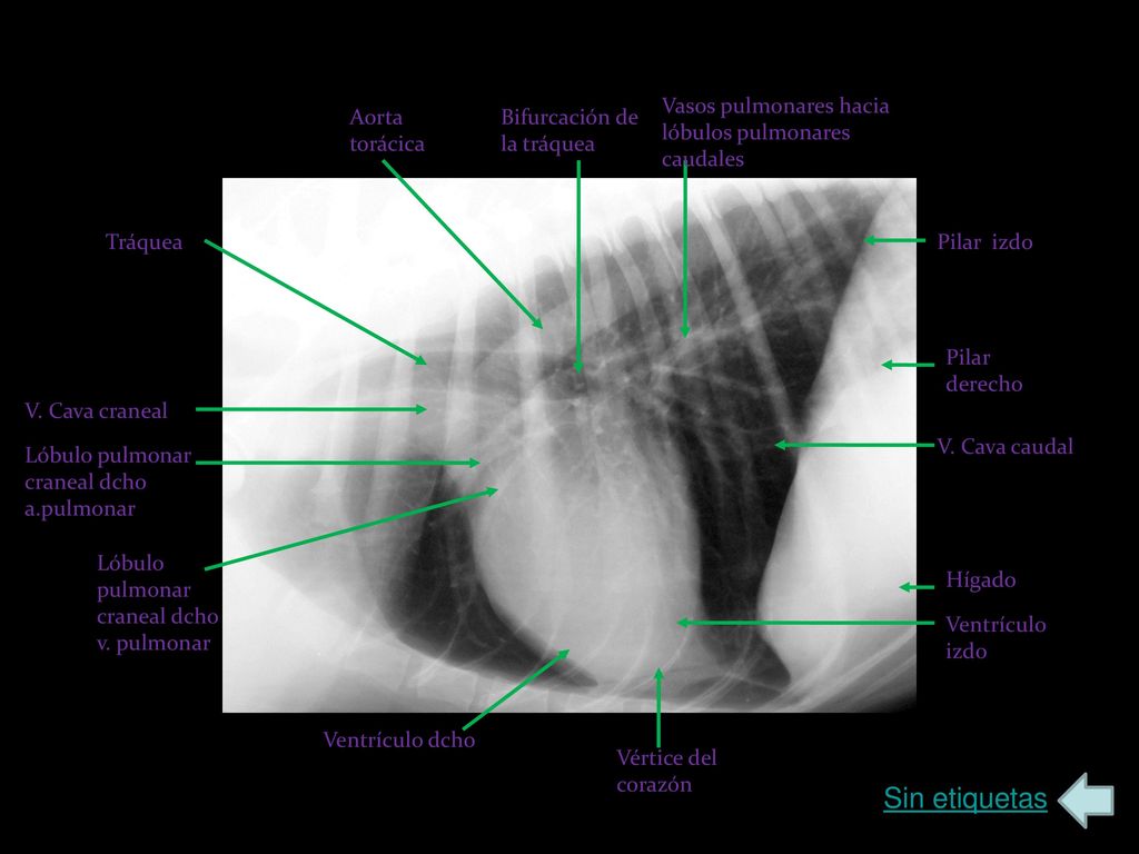 Sin etiquetas Vasos pulmonares hacia lóbulos pulmonares caudales