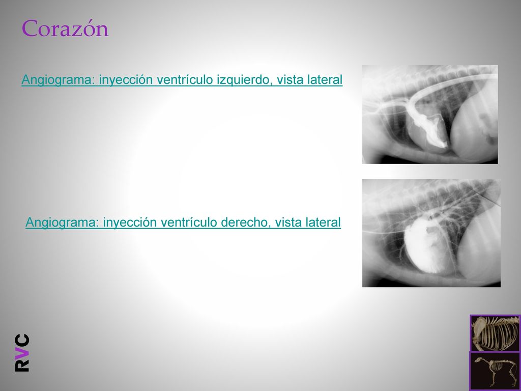 Corazón Angiograma: inyección ventrículo izquierdo, vista lateral