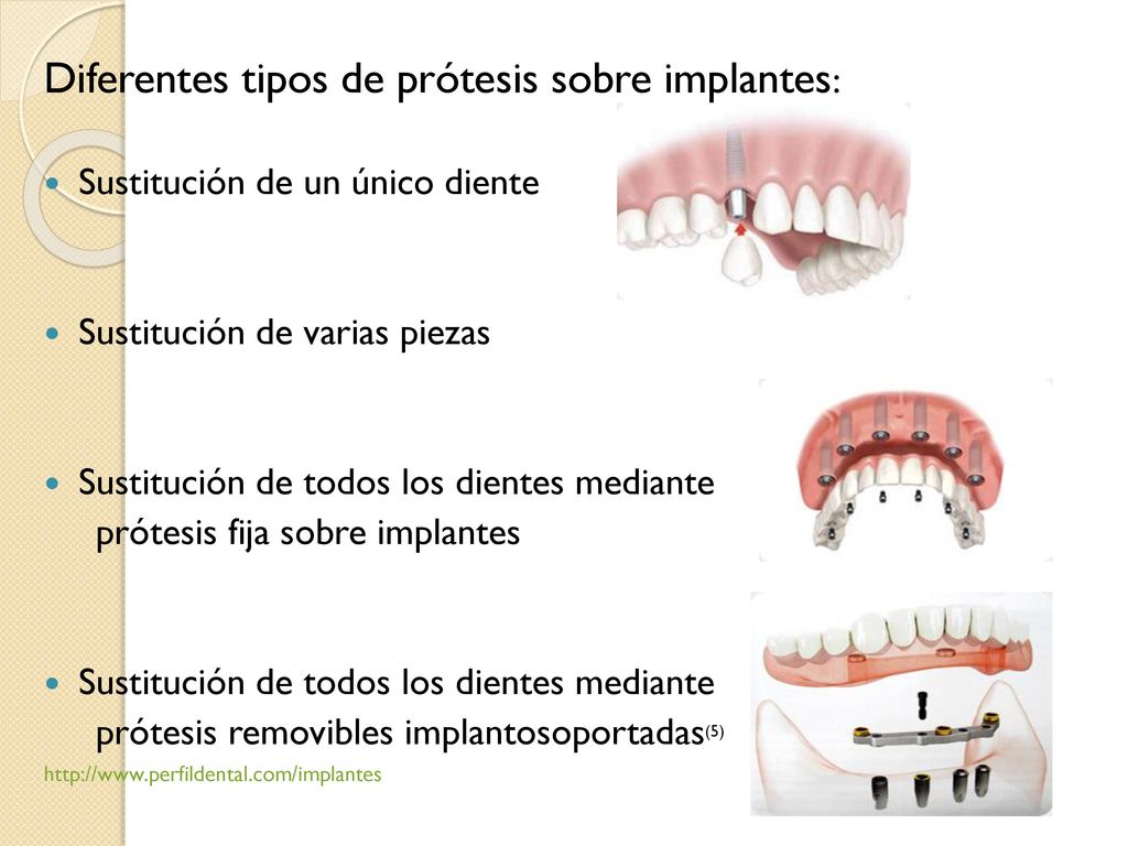 Diferentes tipos de prótesis sobre implantes: