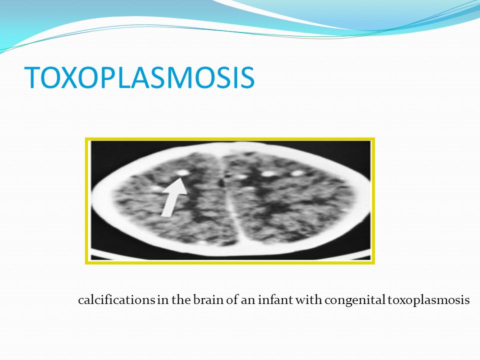 TOXOPLASMOSIS calcifications in the brain of an infant with congenital toxoplasmosis