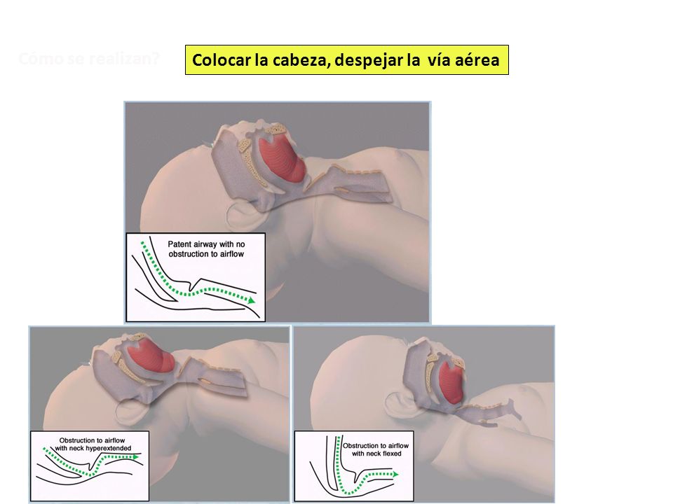 Cómo se realizan Colocar la cabeza, despejar la vía aérea