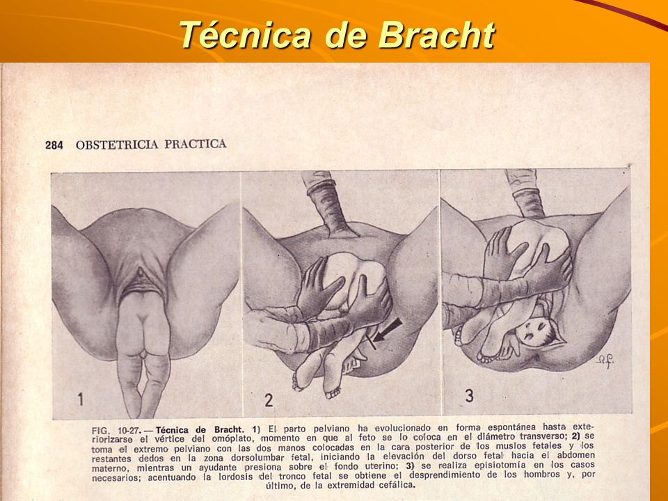 Técnica de Bracht Dra. Cerrato