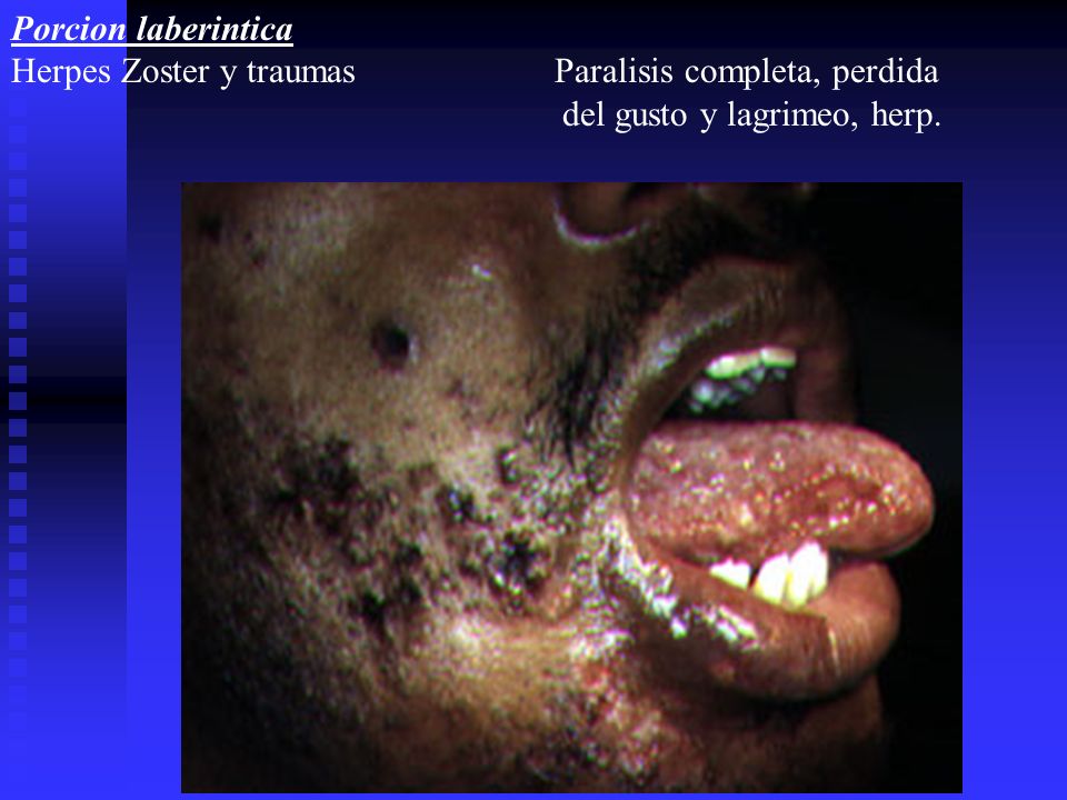 Porcion laberintica Herpes Zoster y traumas Paralisis completa, perdida.