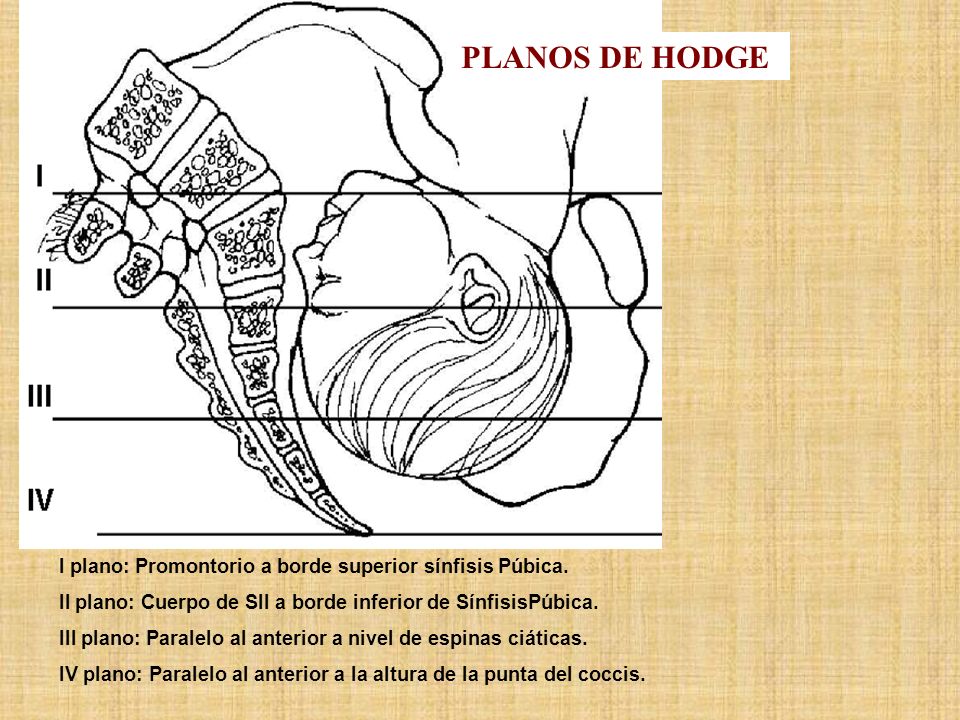 PLANOS DE HODGE I plano: Promontorio a borde superior sínfisis Púbica.