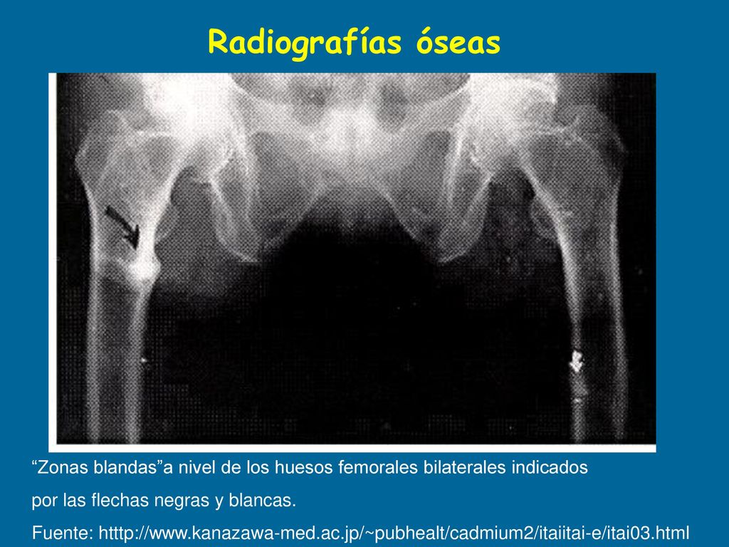 Radiografías óseas Zonas blandas a nivel de los huesos femorales bilaterales indicados. por las flechas negras y blancas.