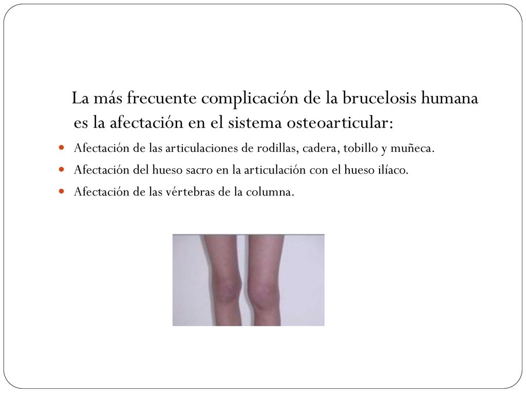 La más frecuente complicación de la brucelosis humana es la afectación en el sistema osteoarticular:
