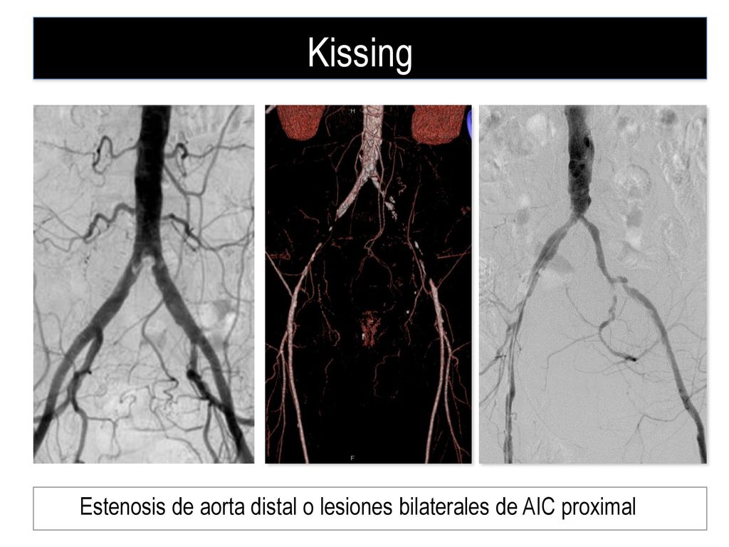 Estenosis de aorta distal o lesiones bilaterales de AIC proximal