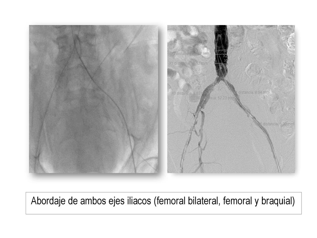 Abordaje de ambos ejes iliacos (femoral bilateral, femoral y braquial)