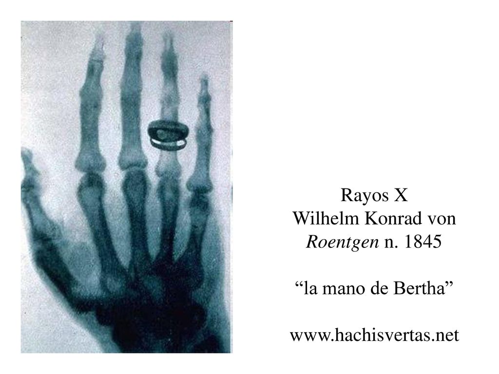Rayos X Wilhelm Konrad von Roentgen n la mano de Bertha www