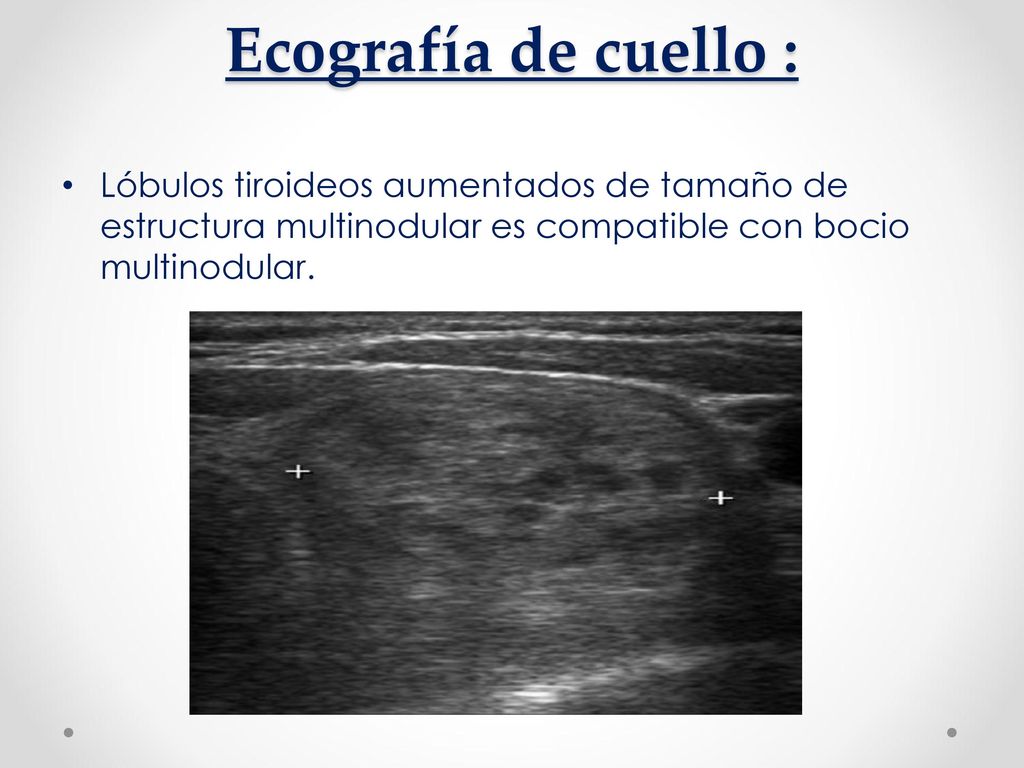 Ecografía de cuello : Lóbulos tiroideos aumentados de tamaño de estructura multinodular es compatible con bocio multinodular.