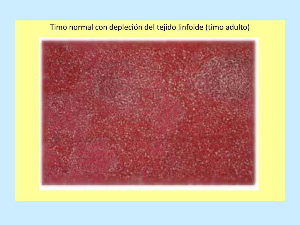 Timo normal con depleción del tejido linfoide (timo adulto)