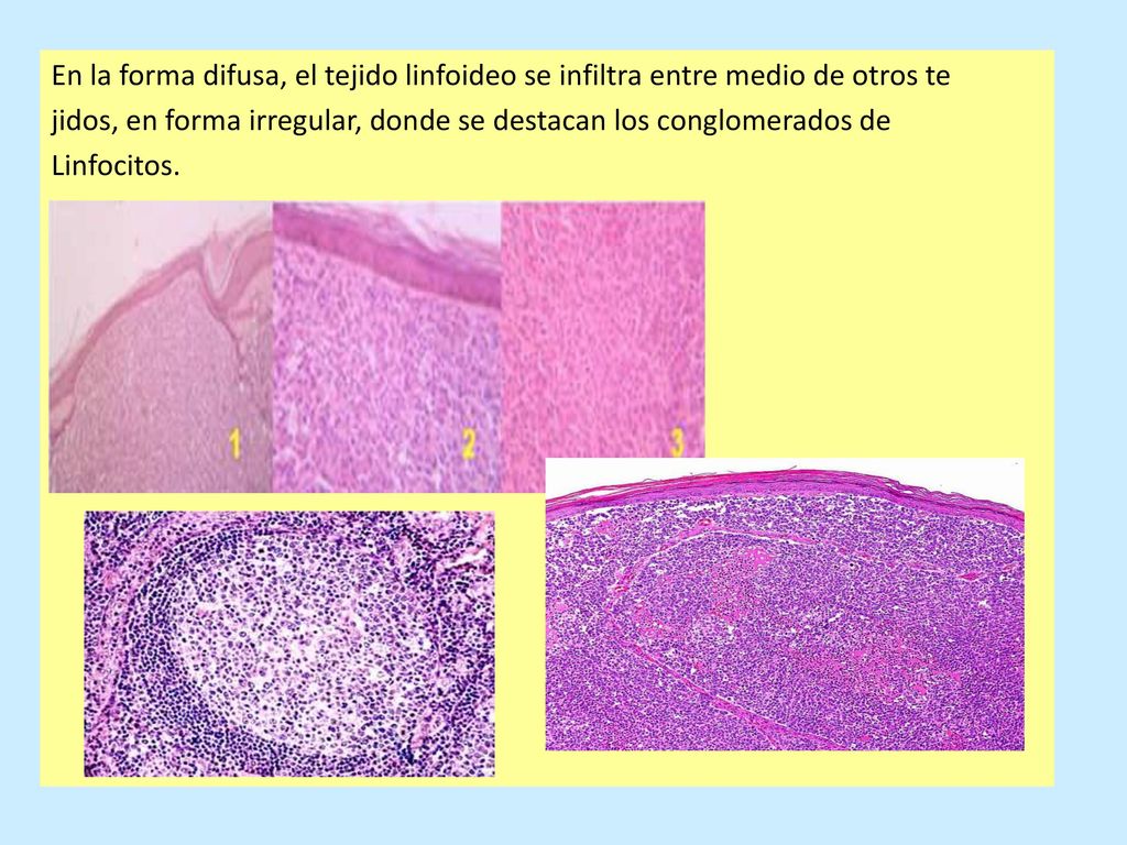 En la forma difusa, el tejido linfoideo se infiltra entre medio de otros te