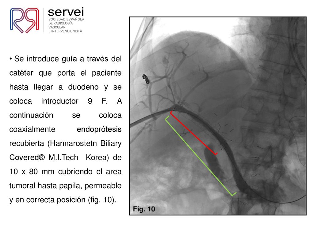 Se introduce guía a través del catéter que porta el paciente hasta llegar a duodeno y se coloca introductor 9 F. A continuación se coloca coaxialmente endoprótesis recubierta (Hannarostetn Biliary Covered® M.I.Tech Korea) de 10 x 80 mm cubriendo el area tumoral hasta papila, permeable y en correcta posición (fig. 10).