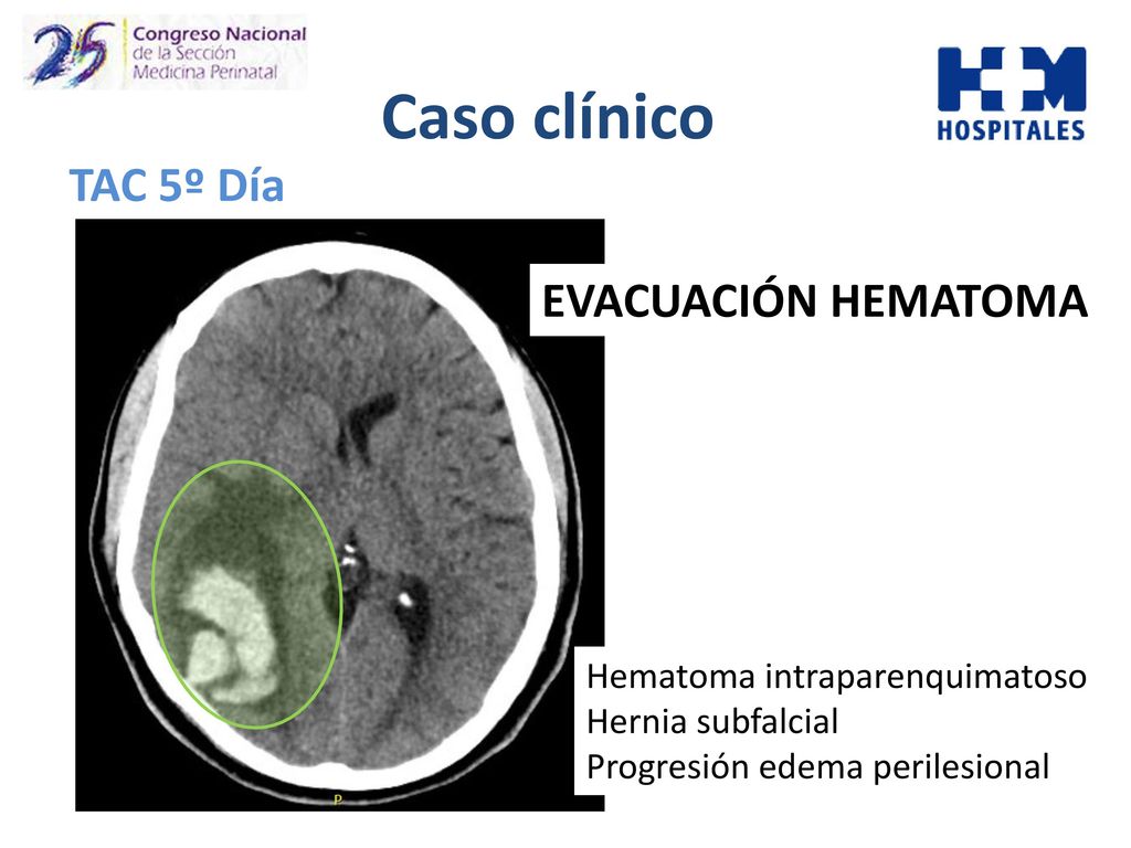 Caso clínico RMN 4º Día TAC 5º Día EVACUACIÓN HEMATOMA