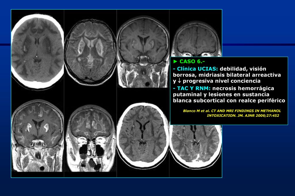 ► CASO Clínica UCIAS: debilidad, visión borrosa, midriasis bilateral arreactiva y  progresiva nivel conciencia.