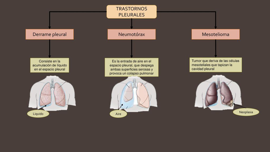 Consiste en la acumulación de líquido en el espacio pleural
