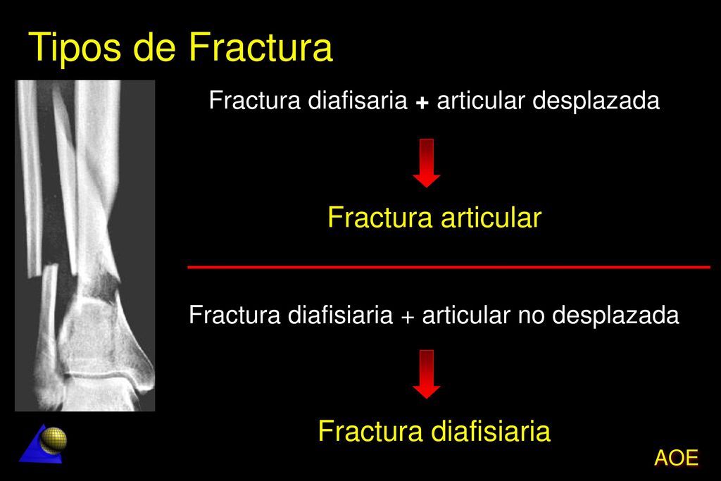 Tipos de Fractura Fractura articular Fractura diafisiaria