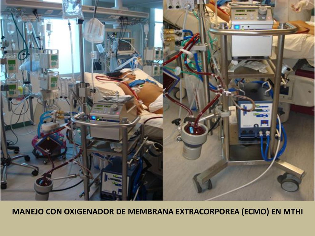 MANEJO CON OXIGENADOR DE MEMBRANA EXTRACORPOREA (ECMO) EN MTHI