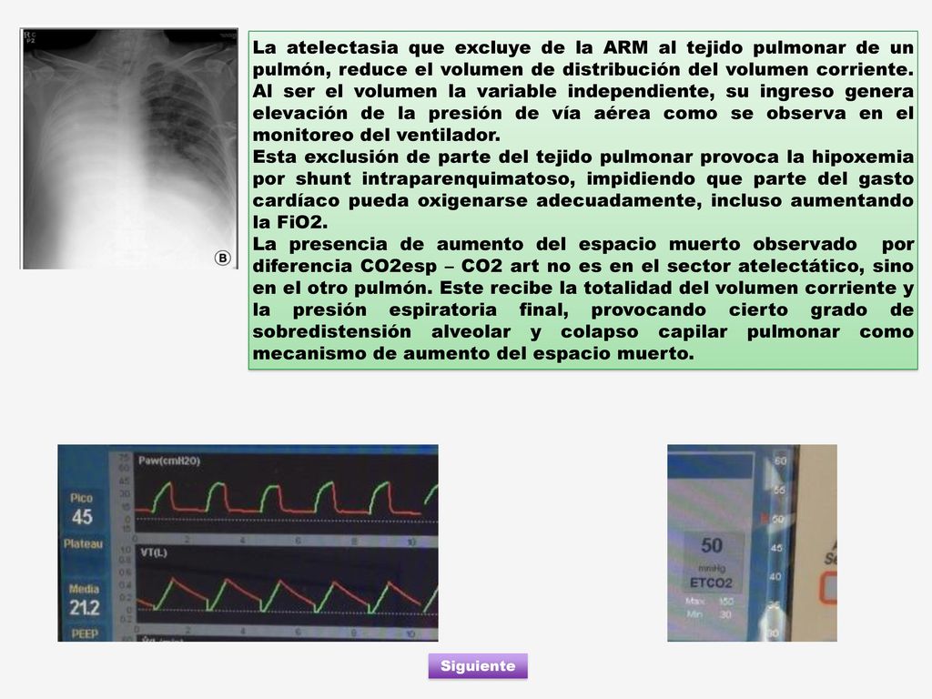 La atelectasia que excluye de la ARM al tejido pulmonar de un pulmón, reduce el volumen de distribución del volumen corriente. Al ser el volumen la variable independiente, su ingreso genera elevación de la presión de vía aérea como se observa en el monitoreo del ventilador.