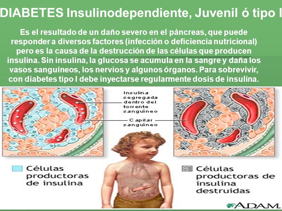 DIABETES Insulinodependiente, Juvenil ó tipo I