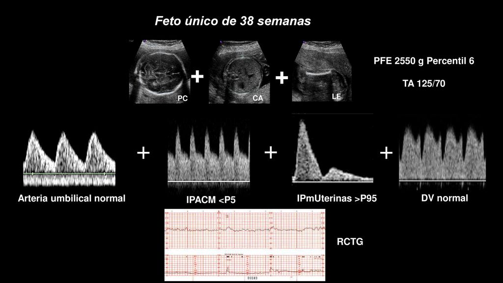 + + Feto único de 38 semanas PFE 2550 g Percentil 6 TA 125/70
