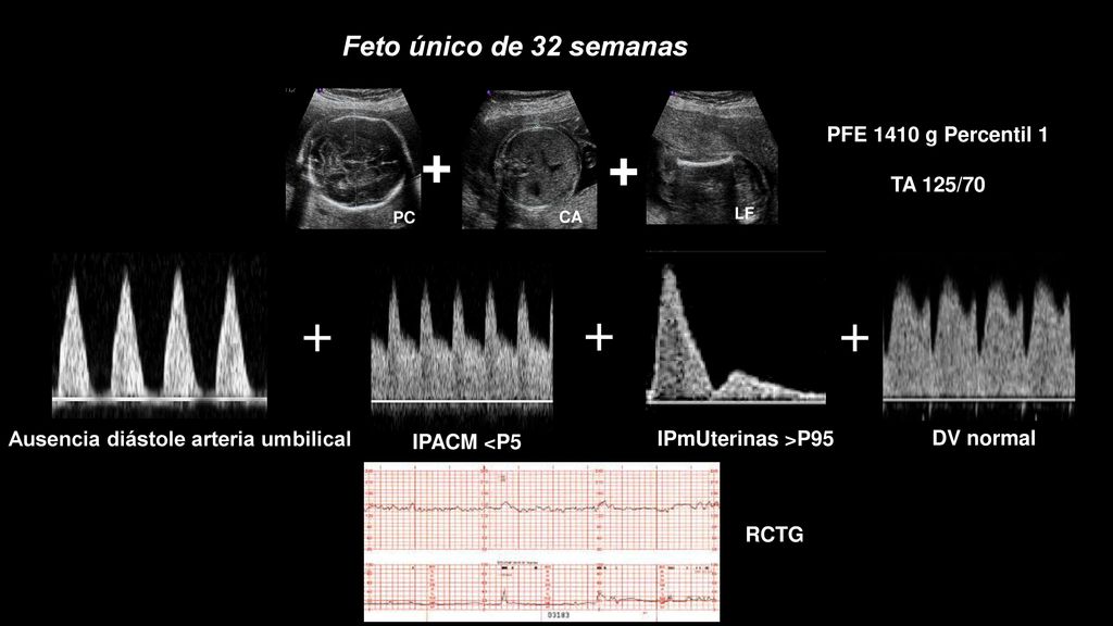 + + Feto único de 32 semanas PFE 1410 g Percentil 1 TA 125/70