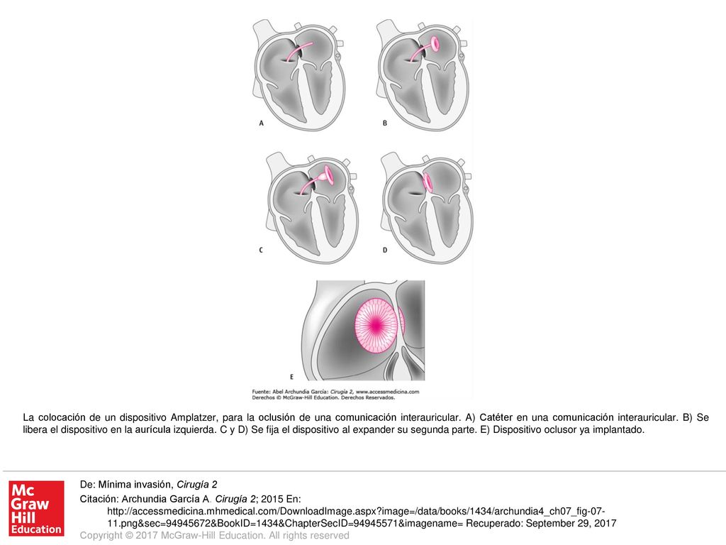 La colocación de un dispositivo Amplatzer, para la oclusión de una comunicación interauricular. A) Catéter en una comunicación interauricular. B) Se libera el dispositivo en la aurícula izquierda. C y D) Se fija el dispositivo al expander su segunda parte. E) Dispositivo oclusor ya implantado.