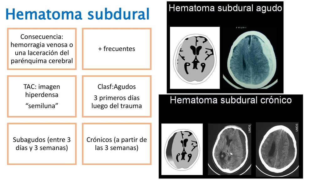 Hematoma subdural Consecuencia: hemorragia venosa o una laceración del parénquima cerebral. + frecuentes.