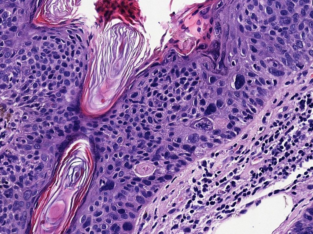 Con queratinocitos grandes, de núcleos pleomórficos, cromatina en grumo grueso, nucléolos marcados y frecuentes mitosis fuera del estrato basal.