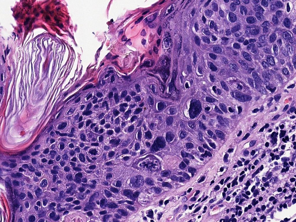 Con queratinocitos grandes, de núcleos pleomórficos, cromatina en grumo grueso, nucléolos marcados y frecuentes mitosis fuera del estrato basal.