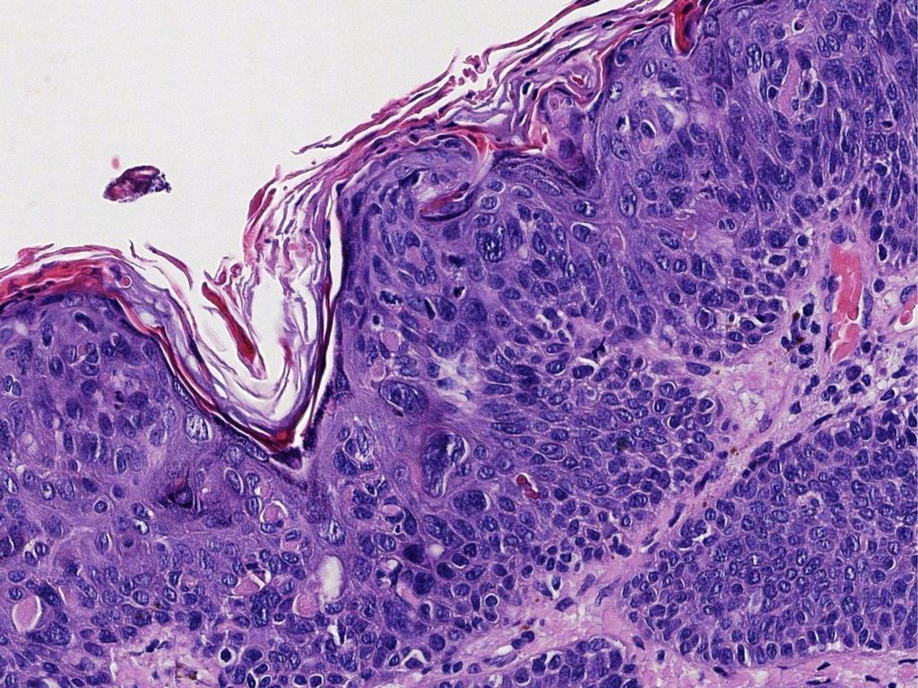 Con queratinocitos grandes, de núcleos pleomórficos, cromatina en grumo grueso, nucléolos marcados y frecuentes mitosis fuera del estrato basal.