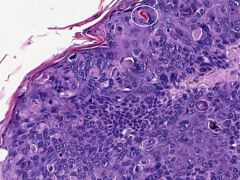 Con queratinocitos grandes, de núcleos pleomórficos, cromatina en grumo grueso, nucléolos marcados y frecuentes mitosis fuera del estrato basal.