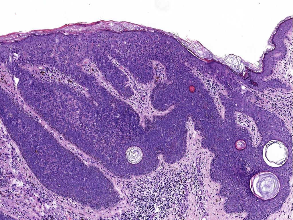 A mayor aumento se puede ver hiperortoqueratosis y focal paraqueratosis de distribución irregular con marcada acantosis.