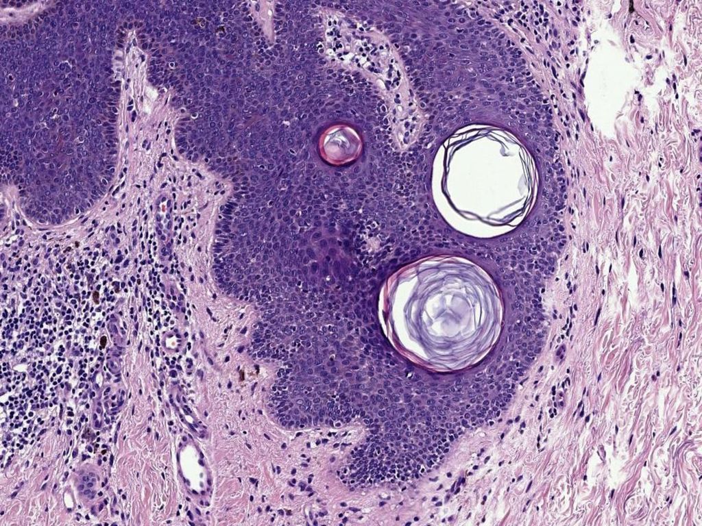 Acantosis a expensas del crecimiento excrecente tanto de células indiferenciadas de hábito basaloide como de células diferenciadas de hábito escamoso, que muestran ocasionales quistes córneos en el interior del epitelio.