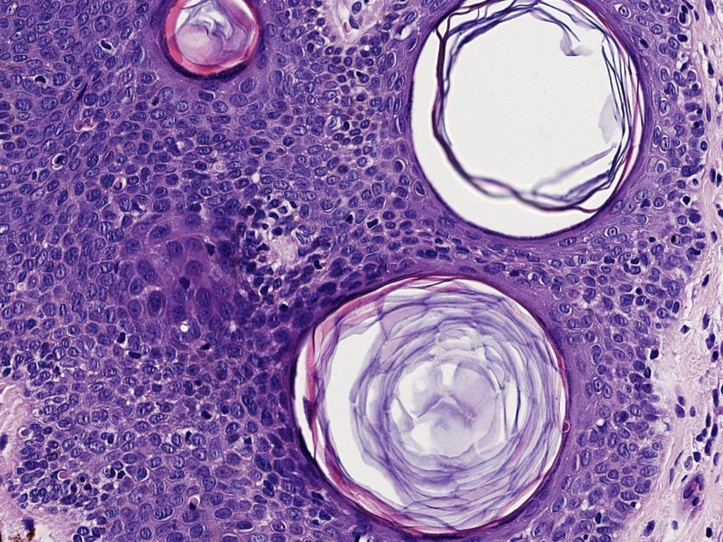 Acantosis a expensas del crecimiento excrecente tanto de células indiferenciadas de hábito basaloide como de células diferenciadas de hábito escamoso, que muestran ocasionales quistes córneos en el interior del epitelio.