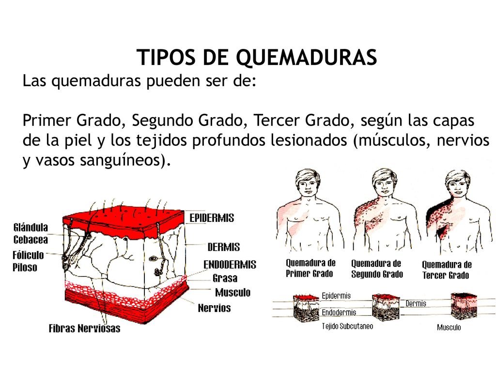 TIPOS DE QUEMADURAS Las quemaduras pueden ser de: