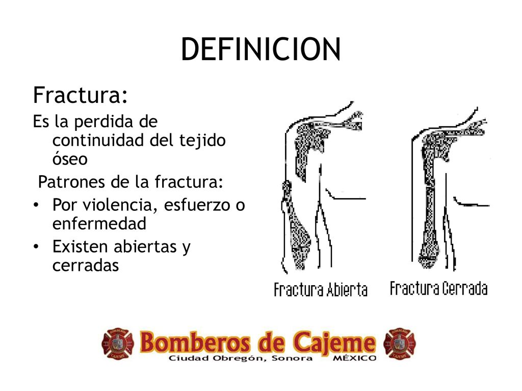 DEFINICION Fractura: Es la perdida de continuidad del tejido óseo