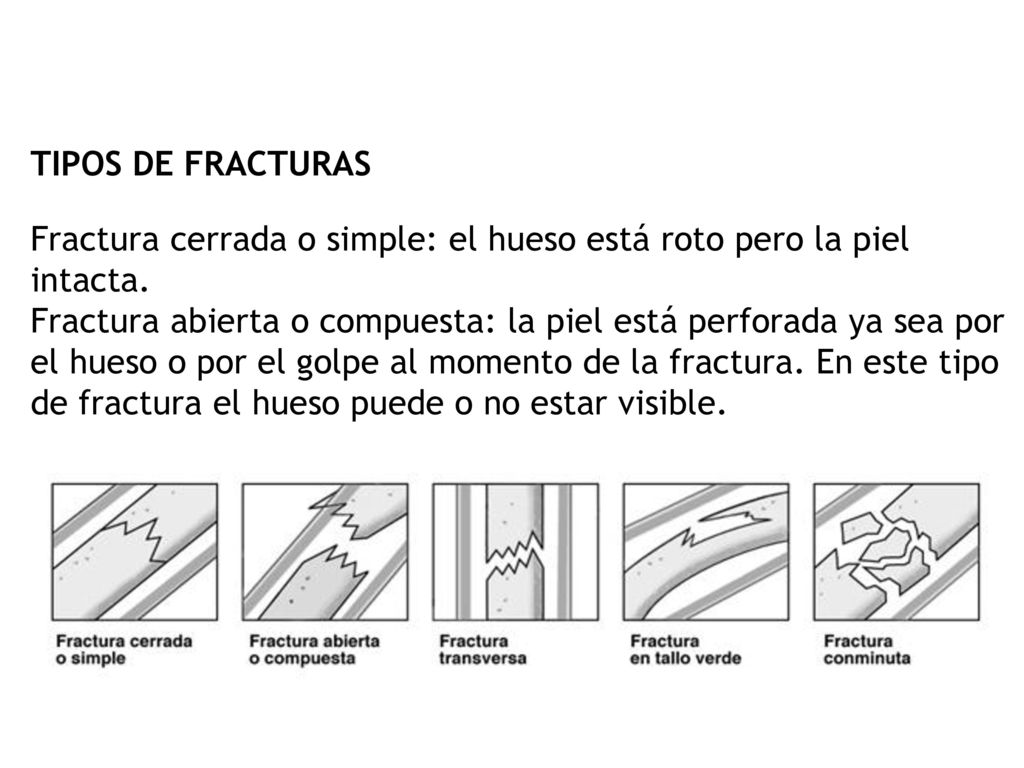 TIPOS DE FRACTURAS Fractura cerrada o simple: el hueso está roto pero la piel intacta.