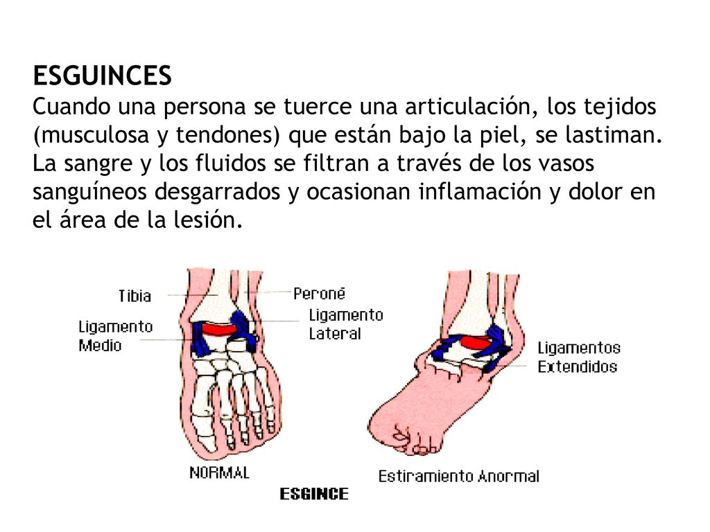 ESGUINCES Cuando una persona se tuerce una articulación, los tejidos (musculosa y tendones) que están bajo la piel, se lastiman.