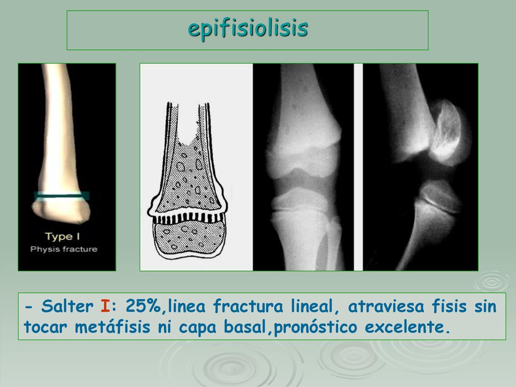 epifisiolisis - Salter I: 25%,linea fractura lineal, atraviesa fisis sin tocar metáfisis ni capa basal,pronóstico excelente.