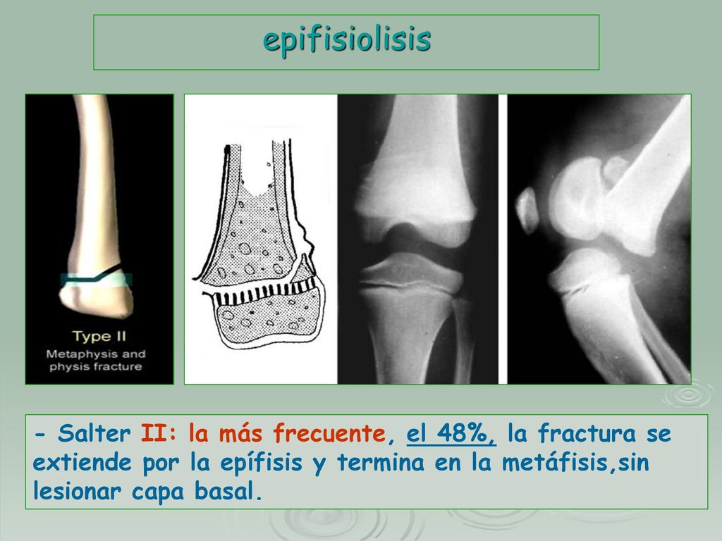 epifisiolisis - Salter II: la más frecuente, el 48%, la fractura se extiende por la epífisis y termina en la metáfisis,sin lesionar capa basal.