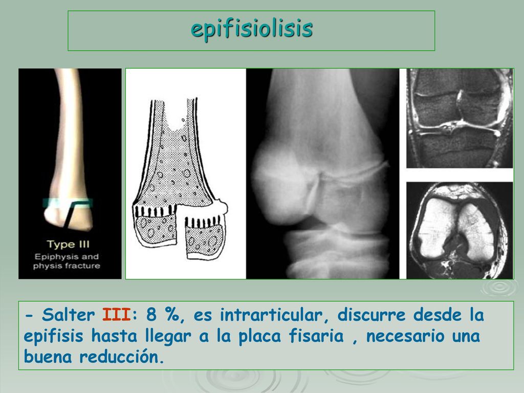 epifisiolisis - Salter III: 8 %, es intrarticular, discurre desde la epifisis hasta llegar a la placa fisaria , necesario una buena reducción.