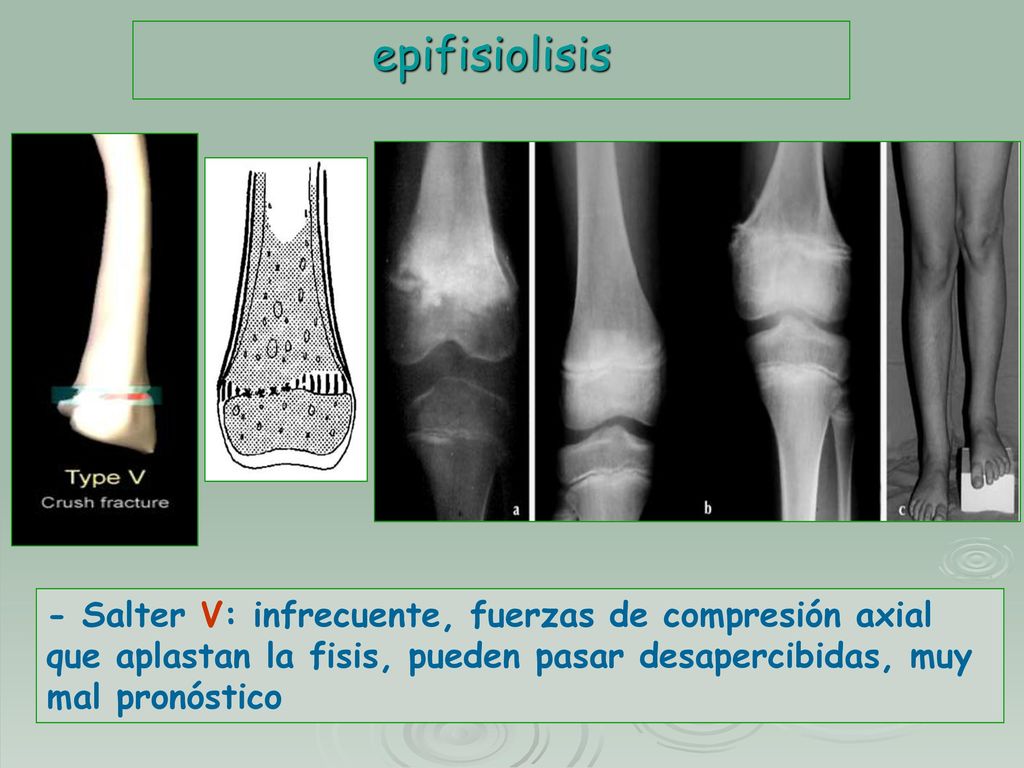 epifisiolisis - Salter V: infrecuente, fuerzas de compresión axial que aplastan la fisis, pueden pasar desapercibidas, muy mal pronóstico.