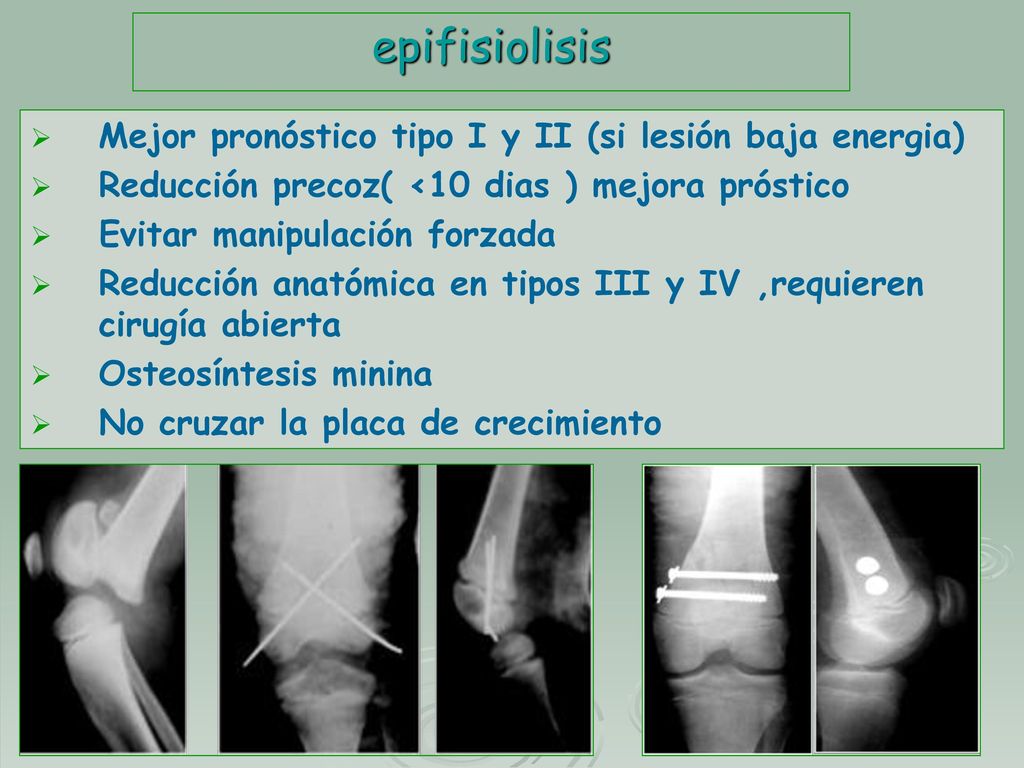 epifisiolisis Mejor pronóstico tipo I y II (si lesión baja energia)