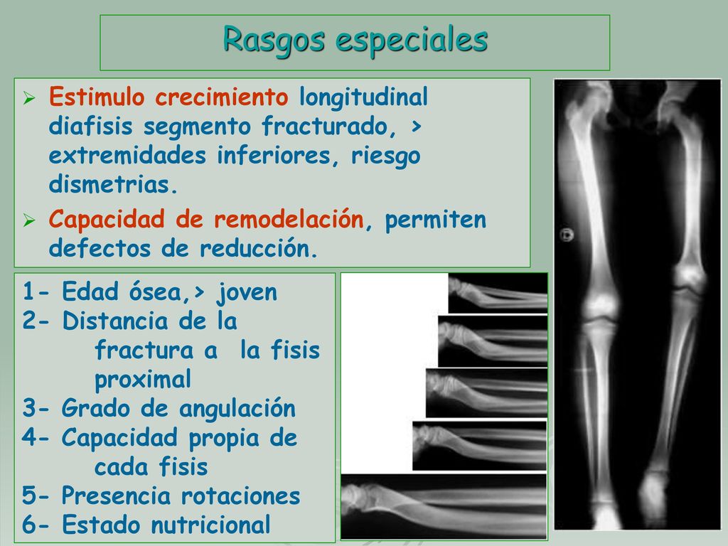 Rasgos especiales Estimulo crecimiento longitudinal diafisis segmento fracturado, > extremidades inferiores, riesgo dismetrias.
