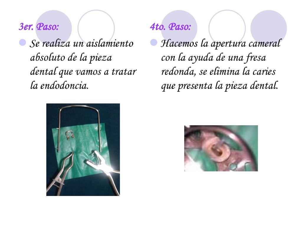 3er. Paso: Se realiza un aislamiento absoluto de la pieza dental que vamos a tratar la endodoncia. 4to. Paso: